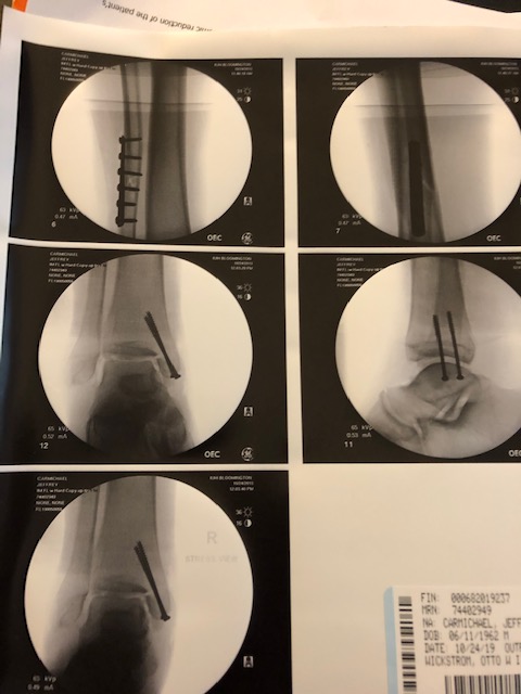 Jeff X-ray Right Leg